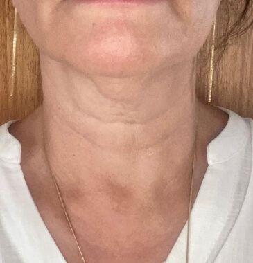 Paralisia de pregas vocais